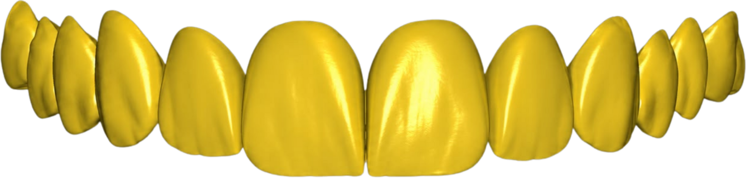 Gold veneers CAD design by Black Duck